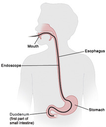upper endoscopy image